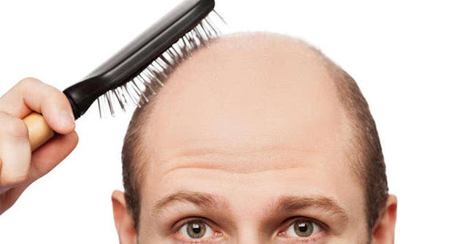 علت ریزش مو - درمان ریزش مو