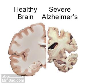 علائم آلزایمر - تشخیص آلزایمر