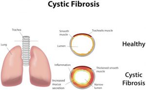 بیماری فیبروز کیستیک چیست - علائم فیبروز کیستیک